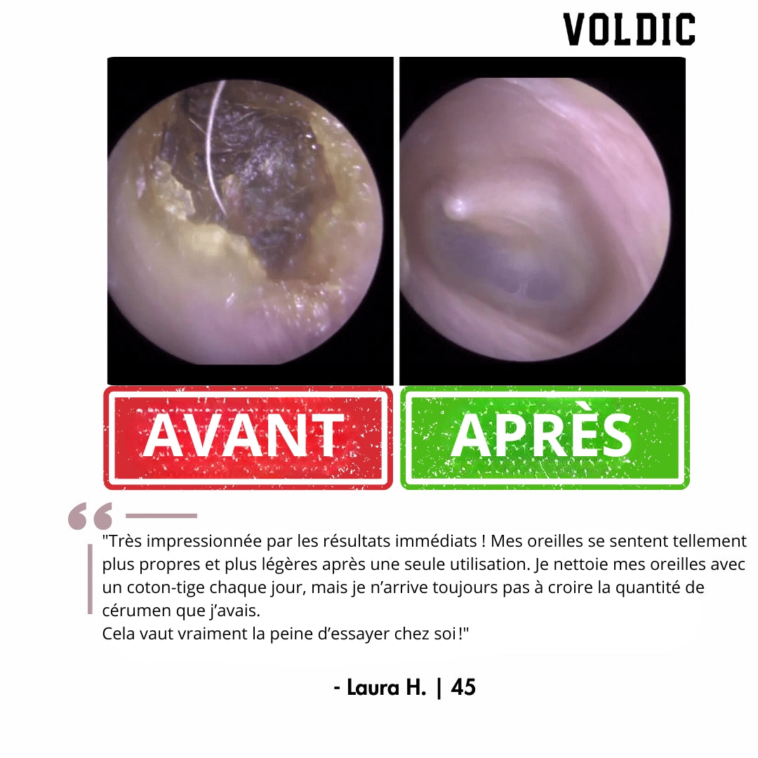 Voldic - Kit électrique de nettoyage des oreilles