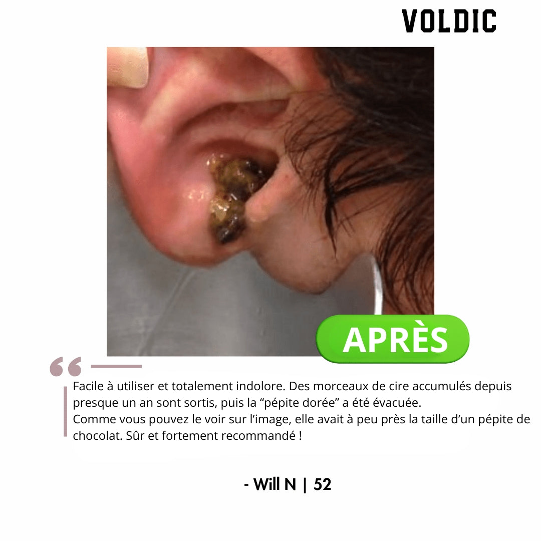 Voldic - Kit électrique de nettoyage des oreilles